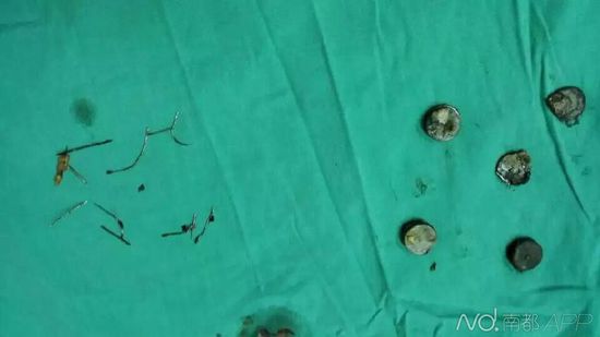 廣西女子為治腹痛吞下10根針9塊磁鐵