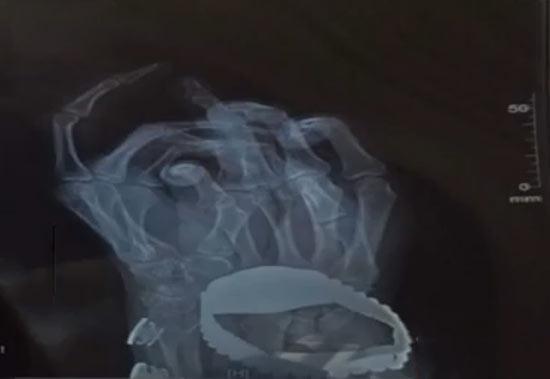 小伙手指斷裂身中“百草枯” 或因前女友報復